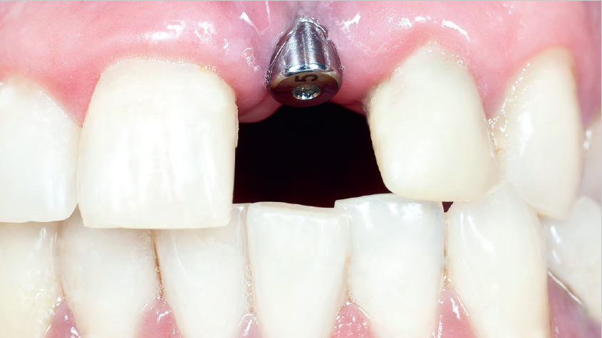 Wybrane metody oceny stabilności wszczepów; fot. iStock