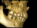 Leczenie ortodontyczno-chirurgiczne pacjenta z dilaceracją