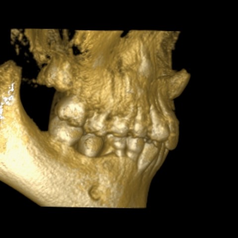 Leczenie ortodontyczno-chirurgiczne pacjenta z dilaceracją