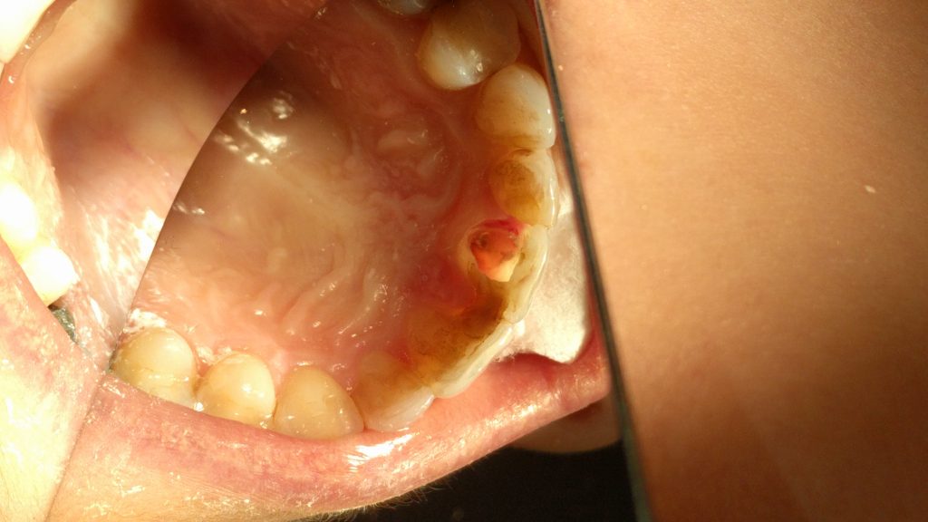 leczenie zębów z resorpcją