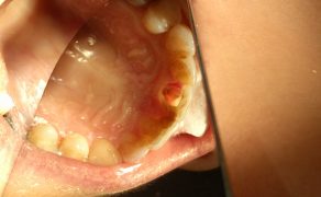 leczenie zębów z resorpcją