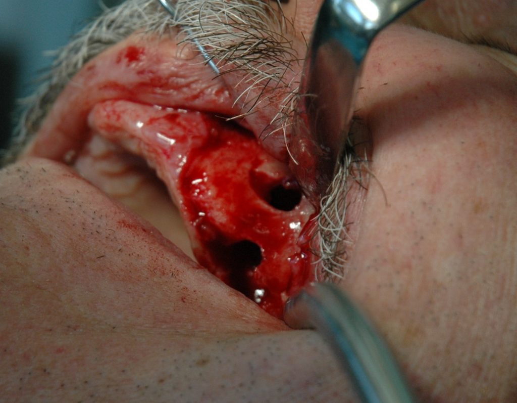 przemieszczenie korzenia