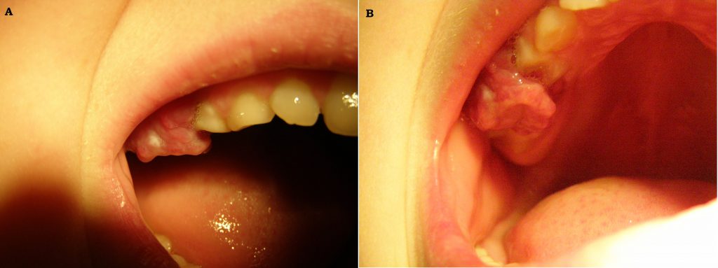 Granuloma pyogenicum