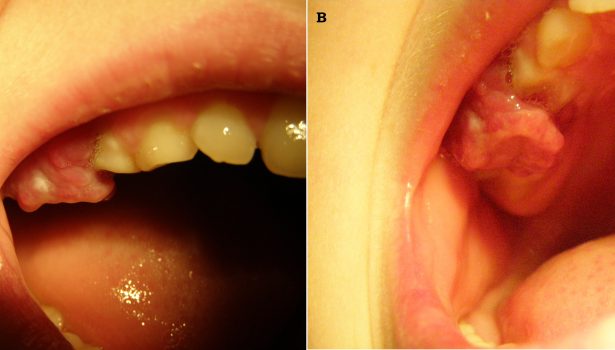 Granuloma pyogenicum