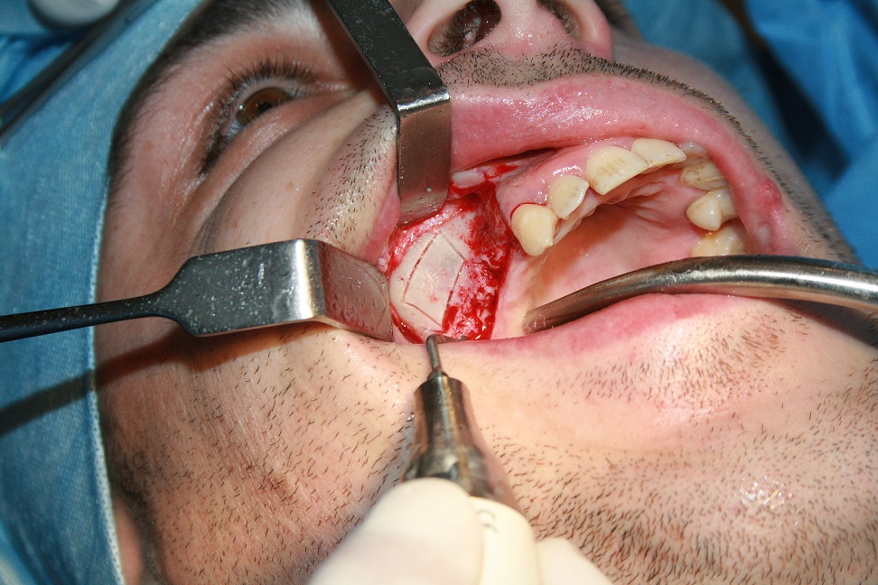 Podniesienie dna zatoki szczękowej