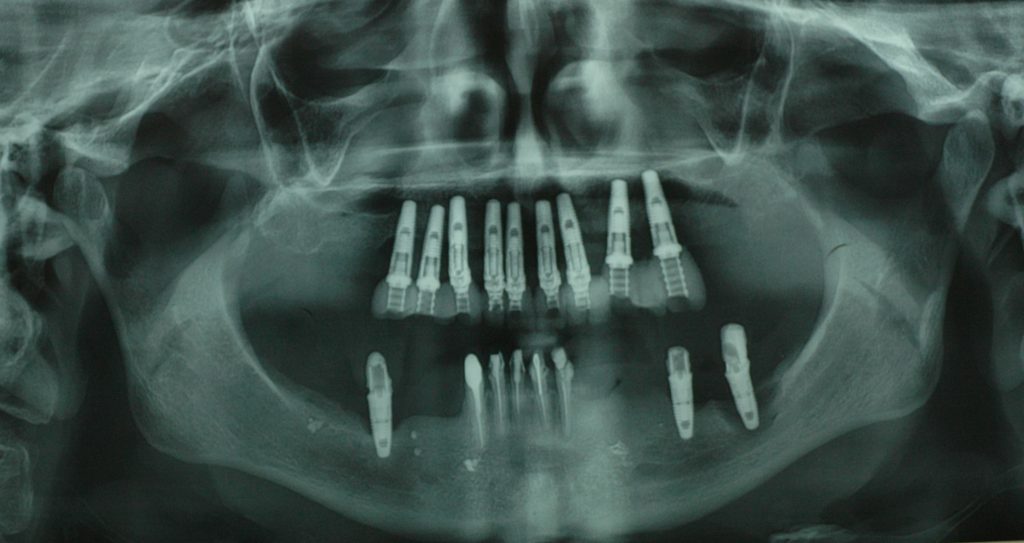 Powikłania leczenia implantoprotetycznego