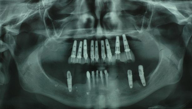 Powikłania leczenia implantoprotetycznego