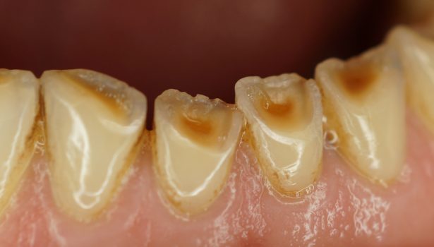 ubytki tkanek twardych