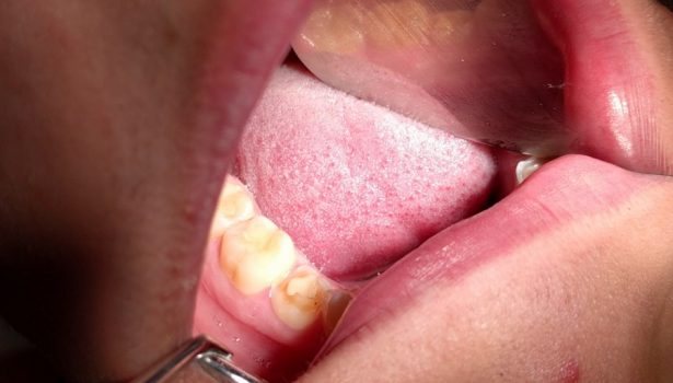 Odbudowa i wydłużenie okluzyjne