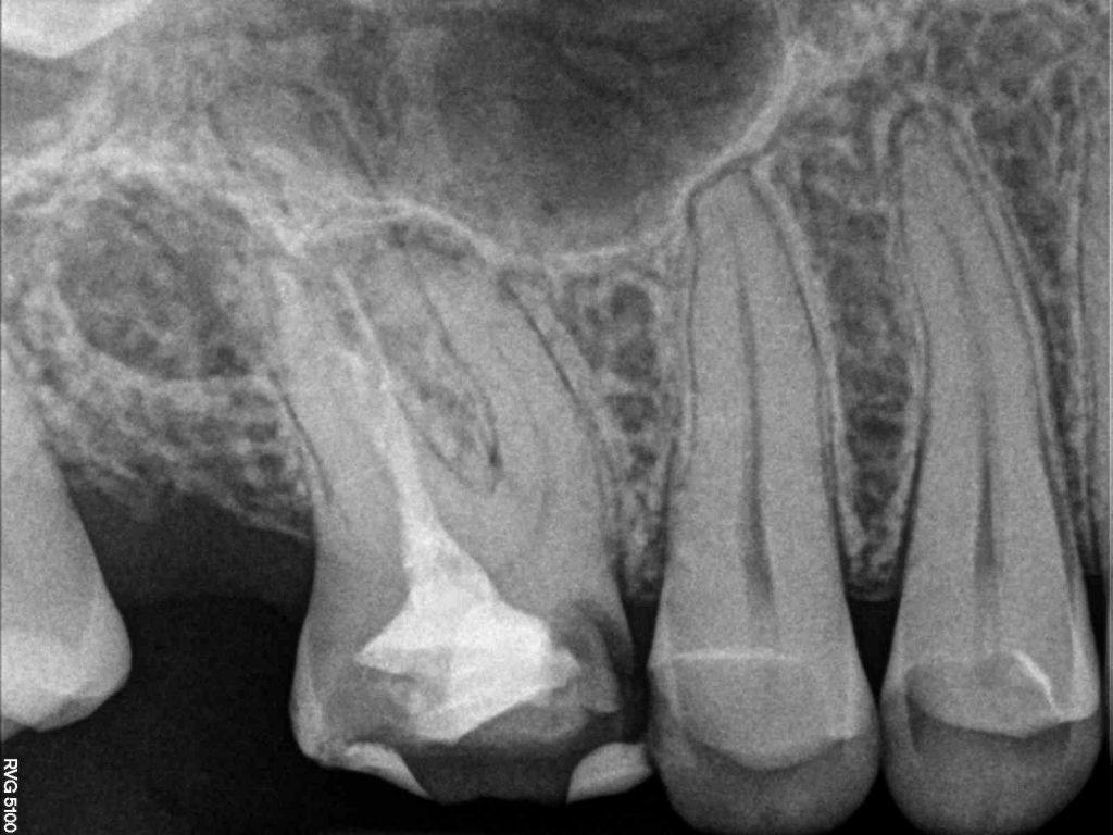 Przewlekłe zapalenie tkanek okołowierzchołkowych