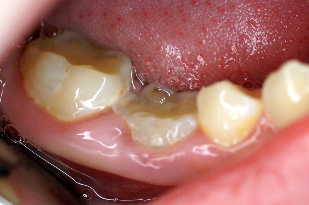 Reinkluzja zębów mlecznych