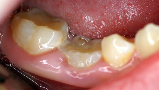 Reinkluzja zębów mlecznych