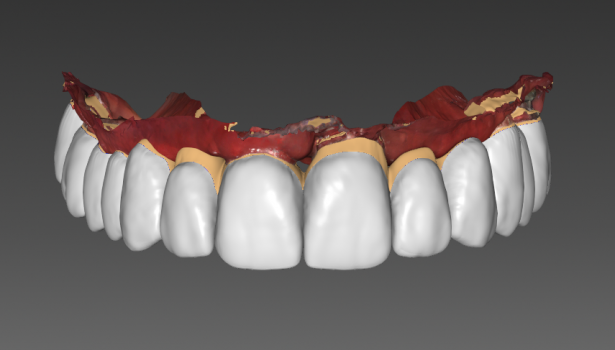 Implantoprotetyka bez modelu Czy to możliwe?