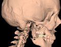 Indywidualny implant tytanowy gałęzi żuchwy – problemy diagnostyczne i lecznicze