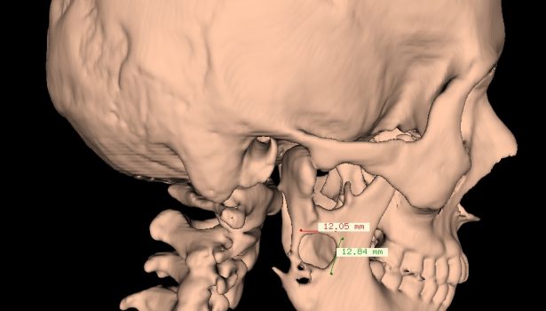 Indywidualny implant tytanowy gałęzi żuchwy – problemy diagnostyczne i lecznicze