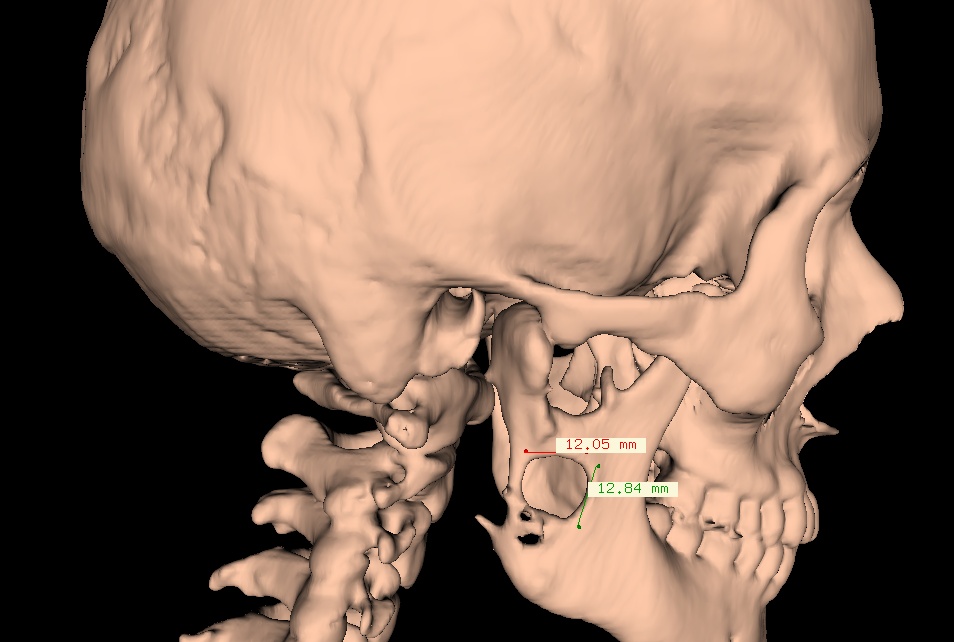 Indywidualny implant tytanowy gałęzi żuchwy – problemy diagnostyczne i lecznicze