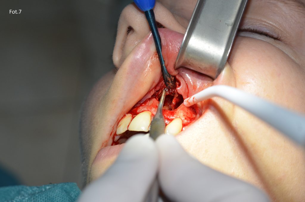 Usunięcie torbieli korzeniowej