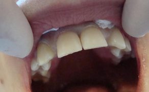 Uzupełnienie braków zębowych