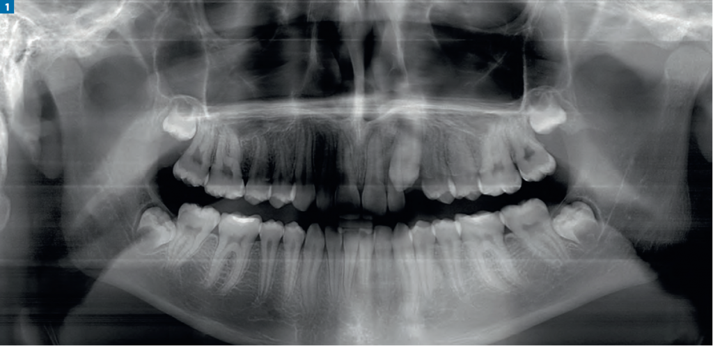 Wprowadzenie zatrzymanego kła górnego