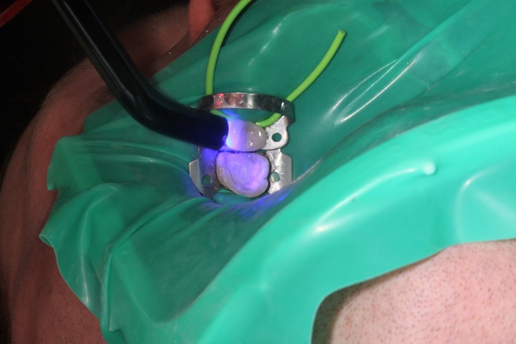 Cementowanie adhezyjne uzupełnień pełnoceramicznych wykonanych z ceramiki krzemowej