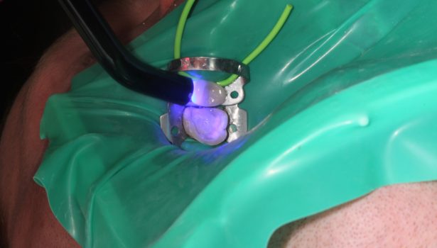 Cementowanie adhezyjne uzupełnień pełnoceramicznych wykonanych z ceramiki krzemowej