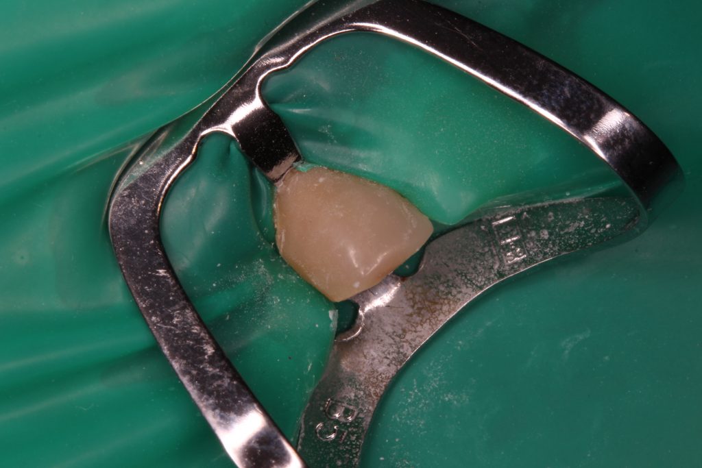 Usunięcie złamanej spirali Lentulo z kanału zęba 12 – opis przypadku