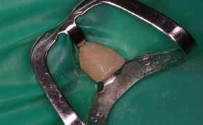Usunięcie złamanej spirali Lentulo z kanału zęba 12 – opis przypadku