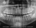 Ząb ektopowy zatrzymany w ścianie bocznej małżowiny nosa – opis przypadku