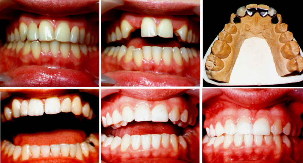 Hipodoncja siekaczy bocznych szczęki – kompleksowe leczenie wielospecjalistyczne