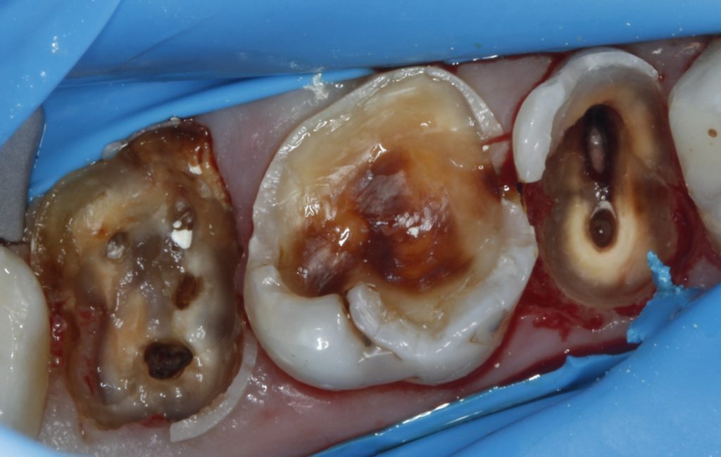 Wkład koronowy kompozytowy