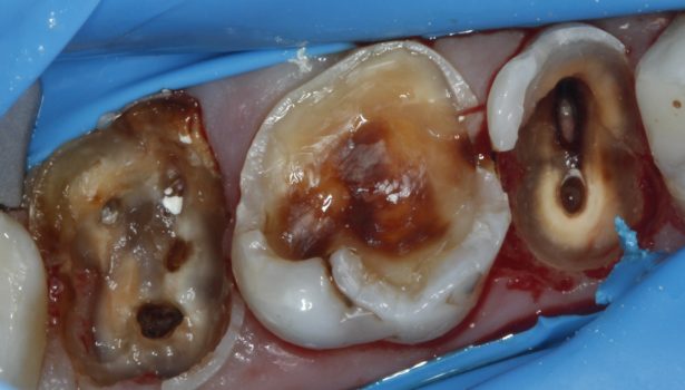 Wkład koronowy kompozytowy