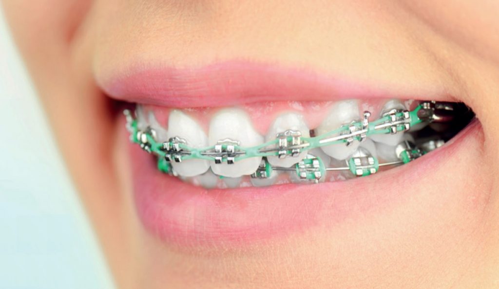 Łuki lecznicze znajdujące zastosowanie we współczesnej ortodoncji