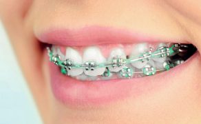 Łuki lecznicze znajdujące zastosowanie we współczesnej ortodoncji