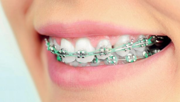 Łuki lecznicze znajdujące zastosowanie we współczesnej ortodoncji