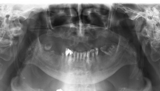 elongacja wyrsotka rylcowatego