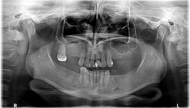 kompleksowe leczenie implantoprotetyczne