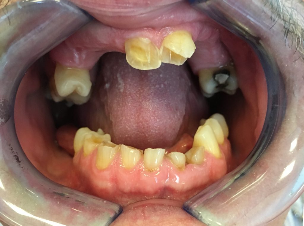 Rehabilitacja protetyczna pacjenta