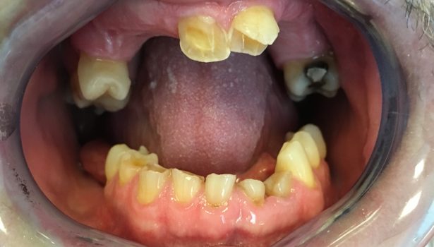 Rehabilitacja protetyczna pacjenta