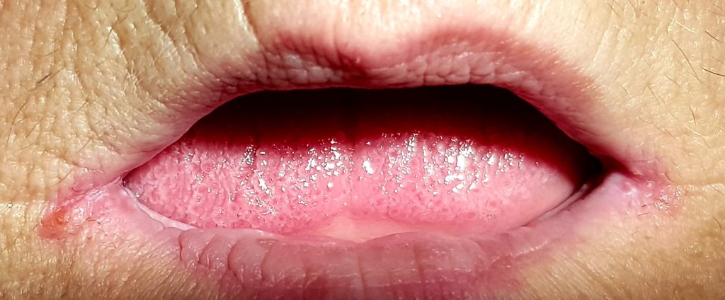 tps-9-2018-zapalenie-kątów-warg-fot.1