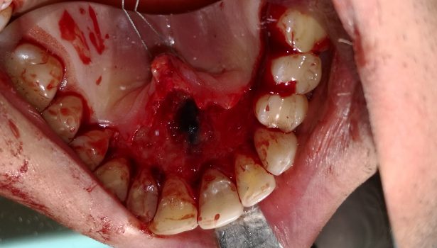 torbiel otworu przysiecznego