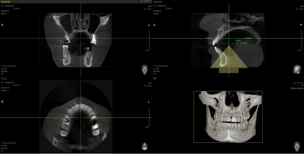 CBCT