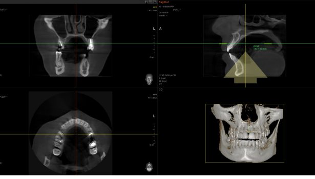 CBCT