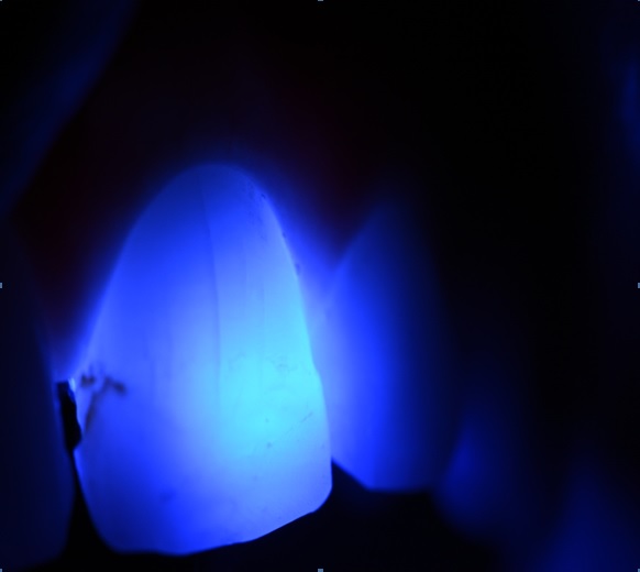 Niecałkowite pęknięcia zębów