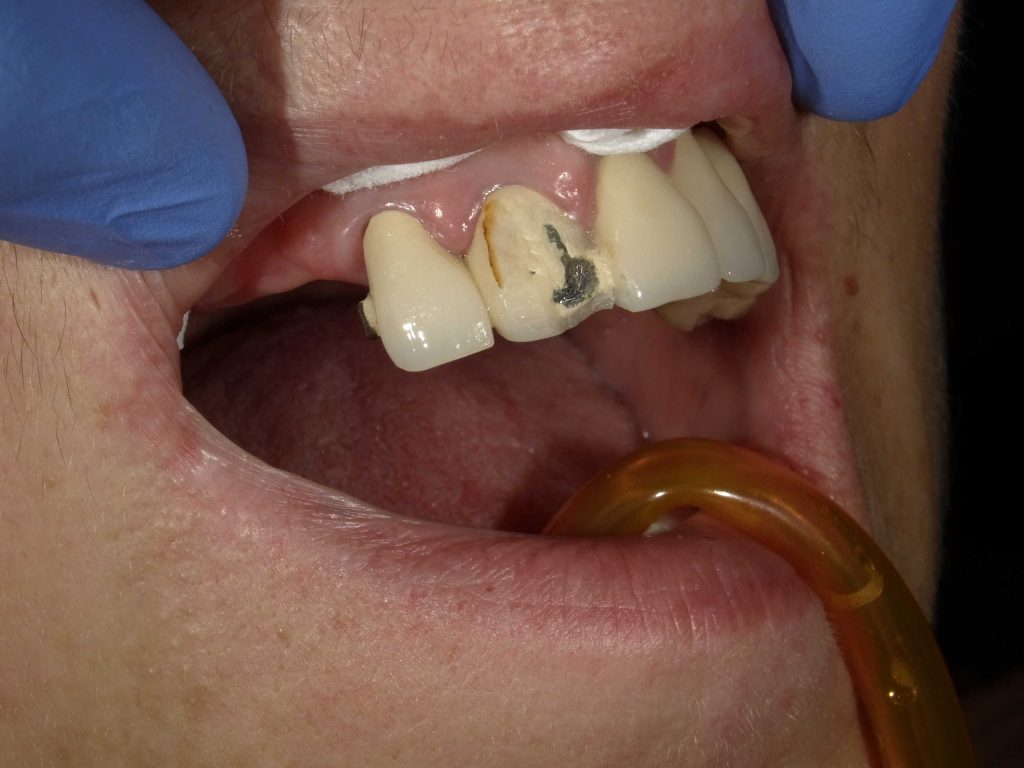 Naprawa uzupełnień ceramicznych