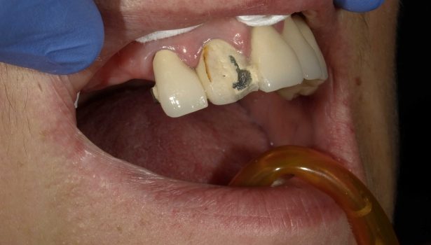 Naprawa uzupełnień ceramicznych