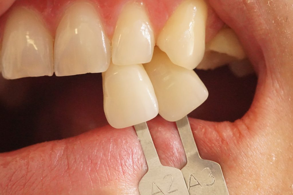 Odbudowa koronami pełnoceramicznymi