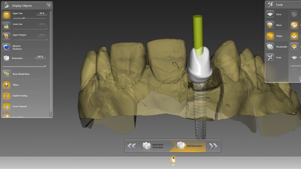 Uzupełnienie braku zęba siecznego