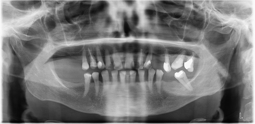 Brak pojedynczego zęba
