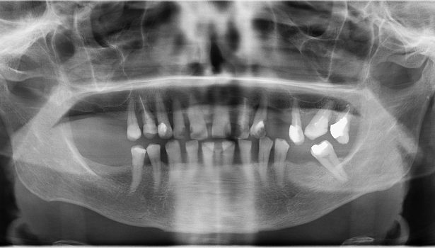 Brak pojedynczego zęba