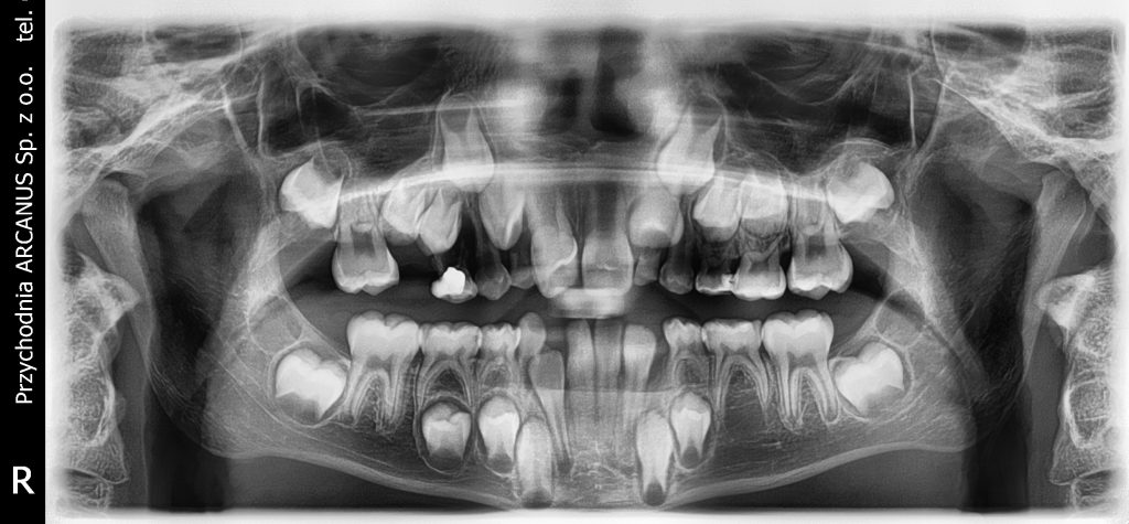 hipodoncja